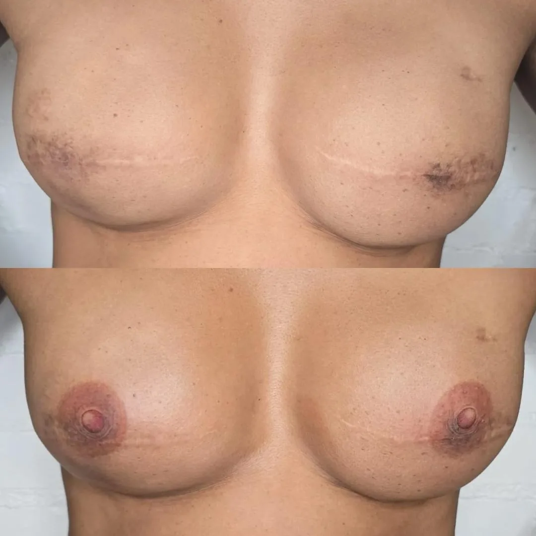 Reconstructed breasts with surgical scars and no areolas before, both areolas and nipples recreated with pigment after — MB Beauty, Las Vegas