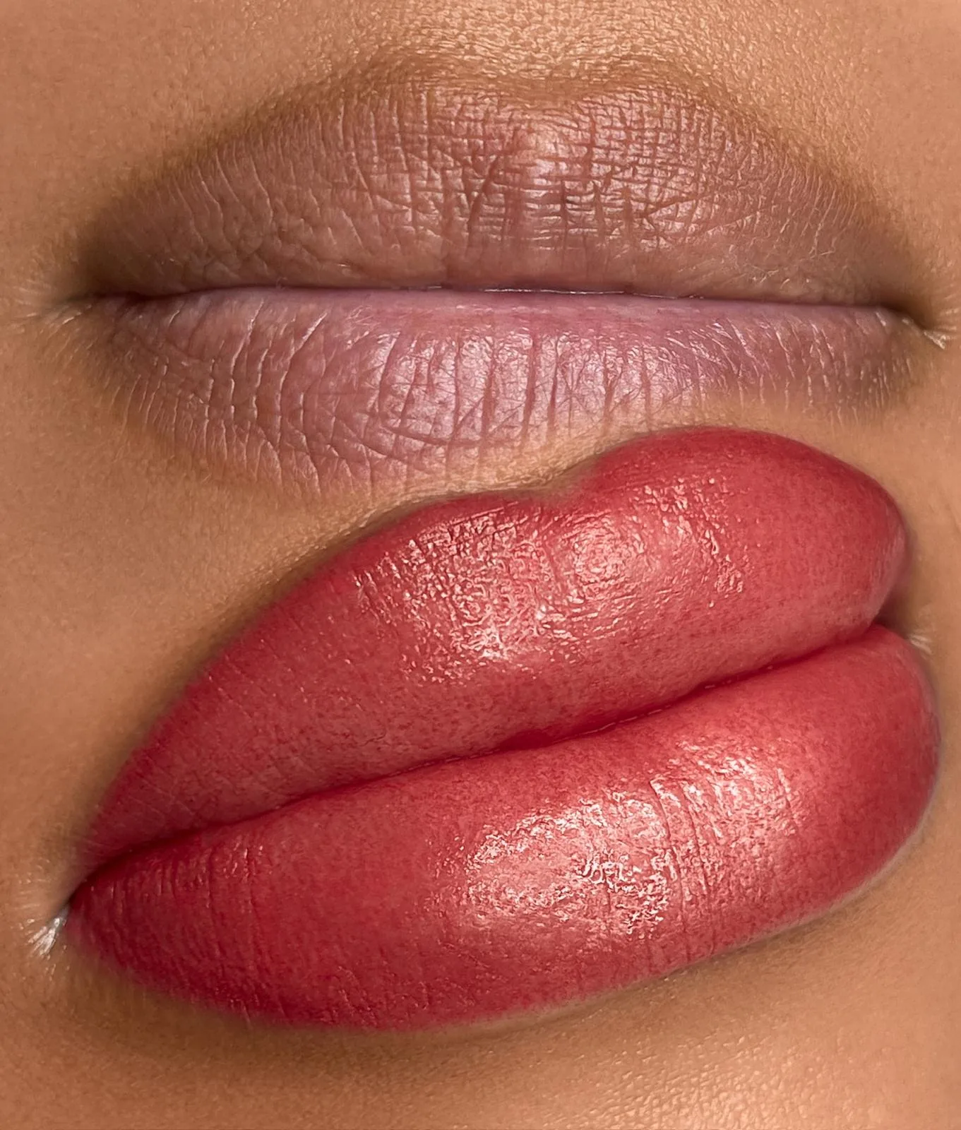 Lip Neutralization before and after