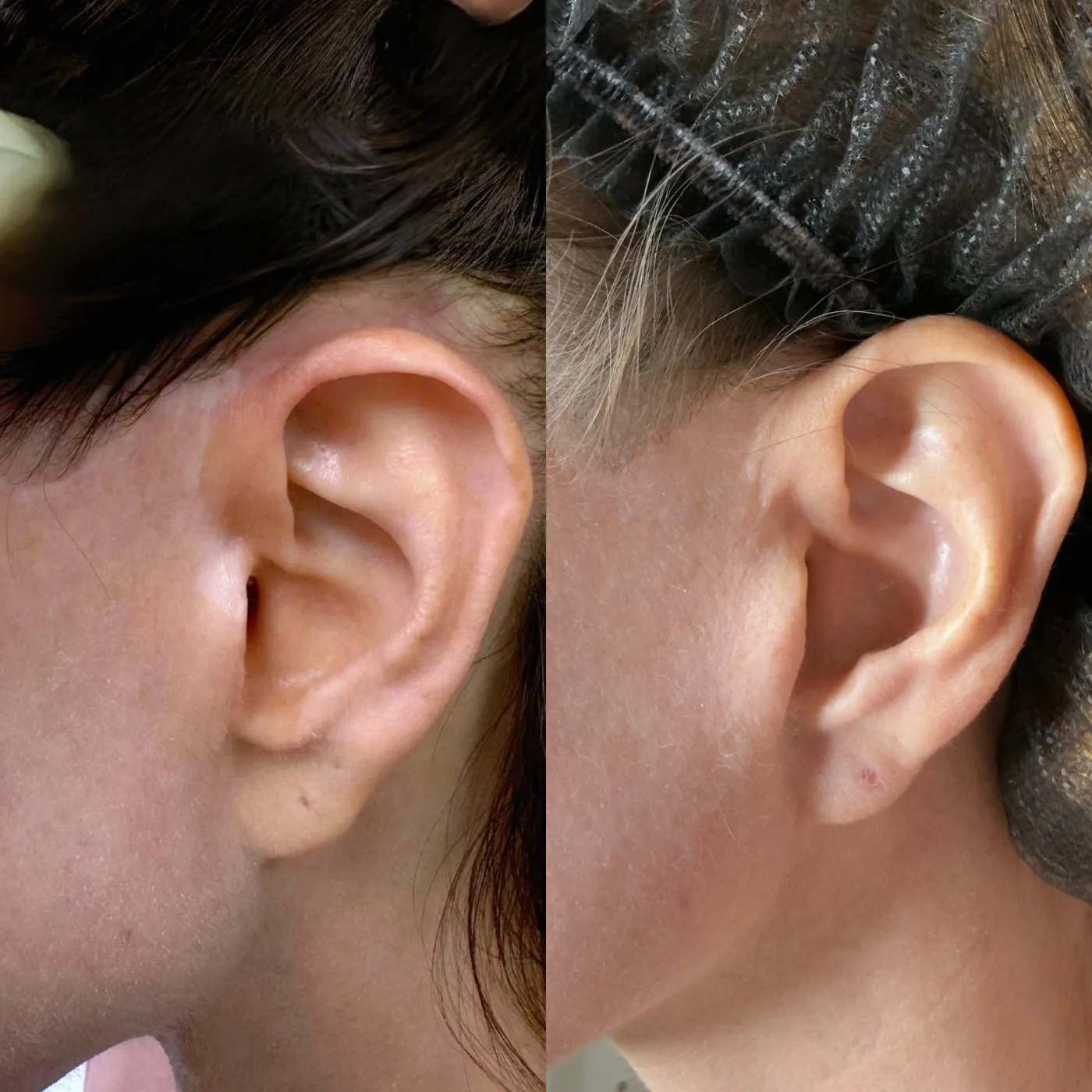 Facelift scar near the ear before, camouflaged to match surrounding skin after — MB Beauty, Las Vegas