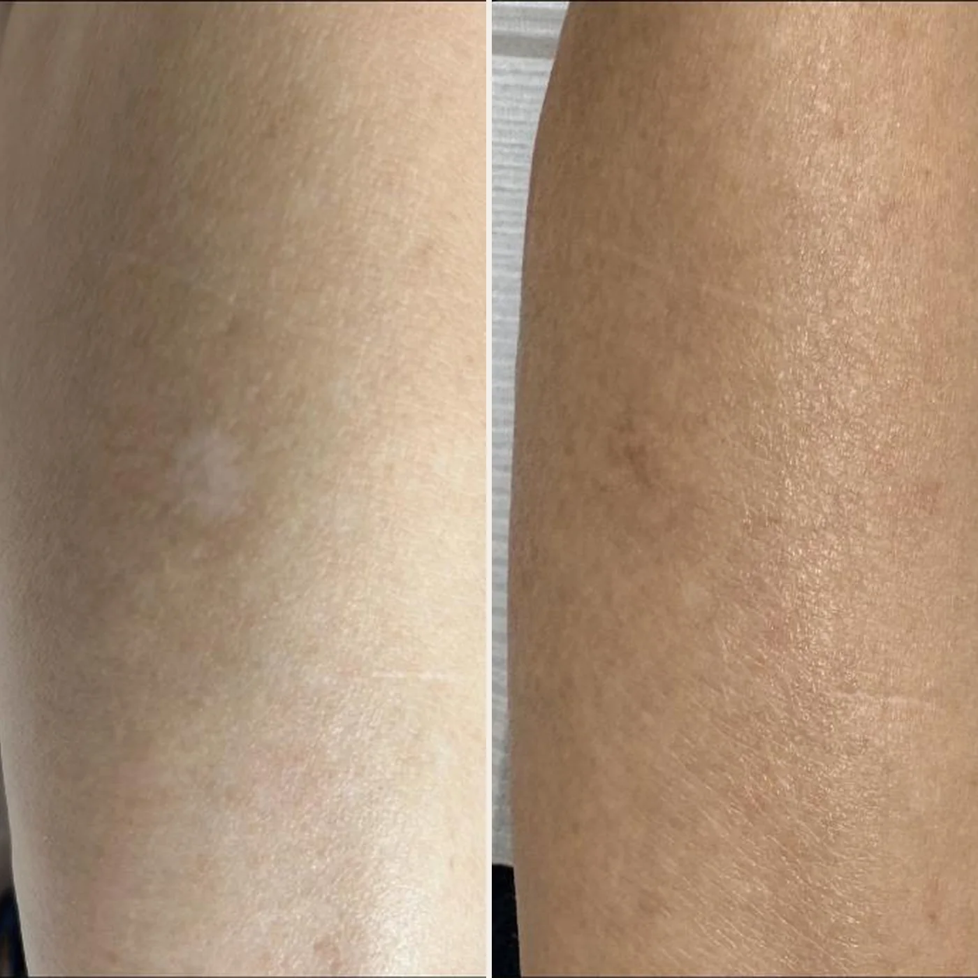 Depigmented patch on the arm before, blended with the surrounding skin tone after — MB Beauty, Las Vegas