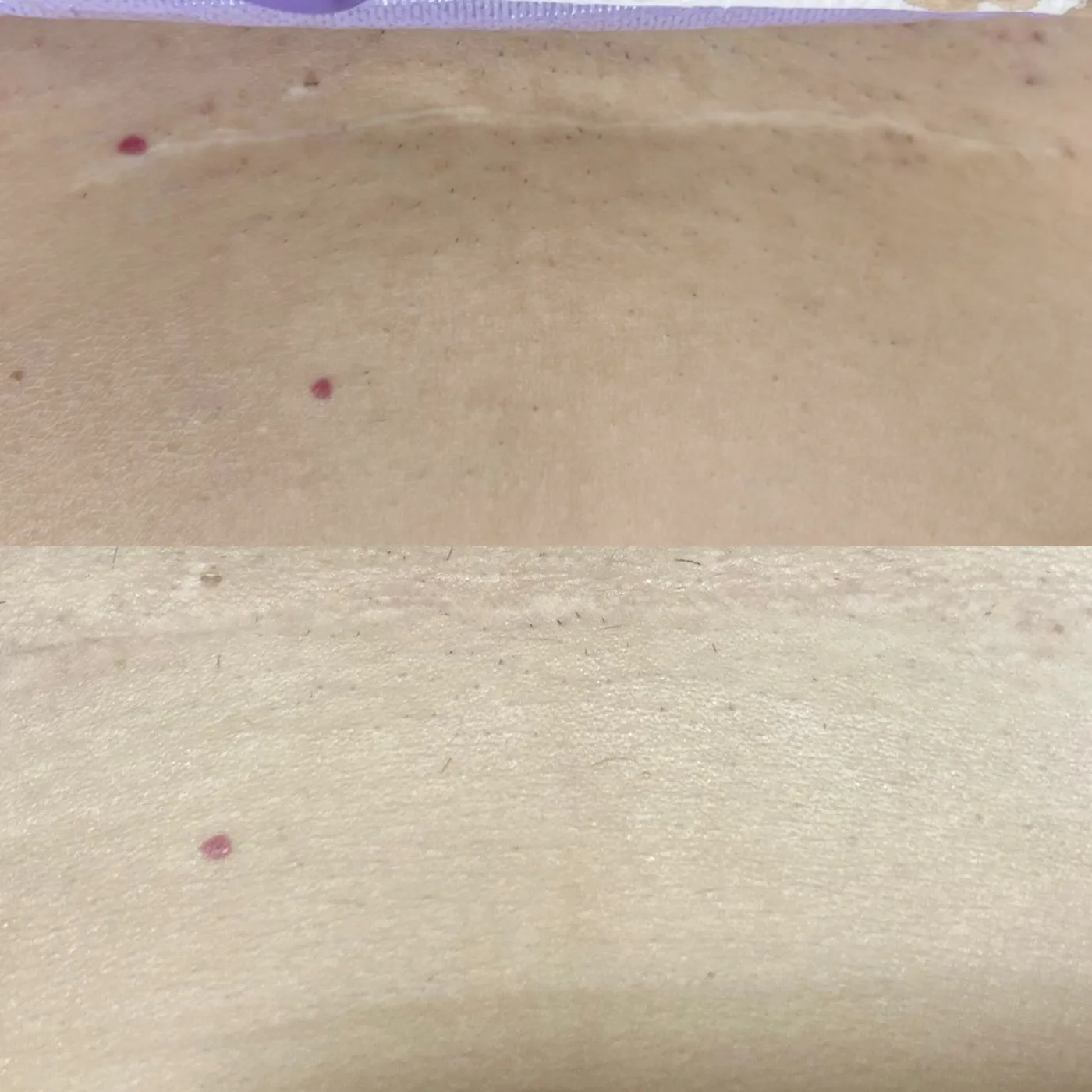 Pale C-section scar on the lower abdomen before, blended with the surrounding skin tone after — MB Beauty, Las Vegas